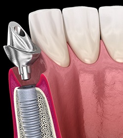 A 3D illustration of a dental implant’s abutment
