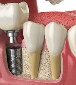 A 3D illustration of a dental implant’s final restoration being placed