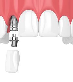 dental implant with a crown in the upper arch