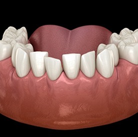 Illustration of crowded teeth