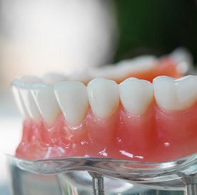 a model of implant dentures