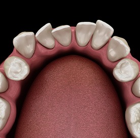 Illustration of gapped teeth