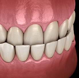 Illustration of an underbite
