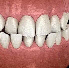 Illustration of a crossbite