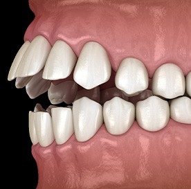 Illustration of an open bite