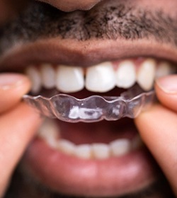 person placing Invisalign trays into their mouth