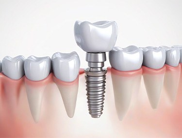 A dental implant model