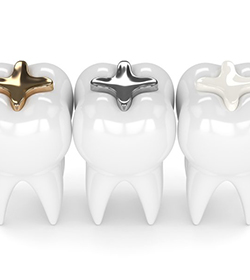 tooth with gold filling, tooth with silver filling, and tooth with composite filling 
