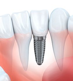 dental implant with a crown in the lower jaw 