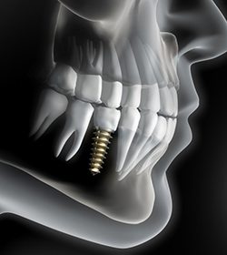 X-ray of a person with a dental implant 