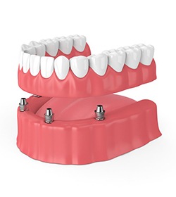 four dental implants securing a denture into place