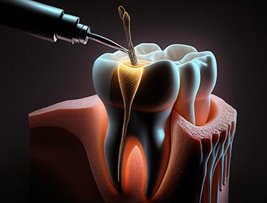 Digital image of a root canal