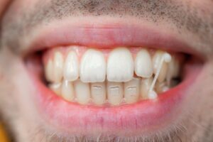 Close-up of mouth with Invisalign attachment.